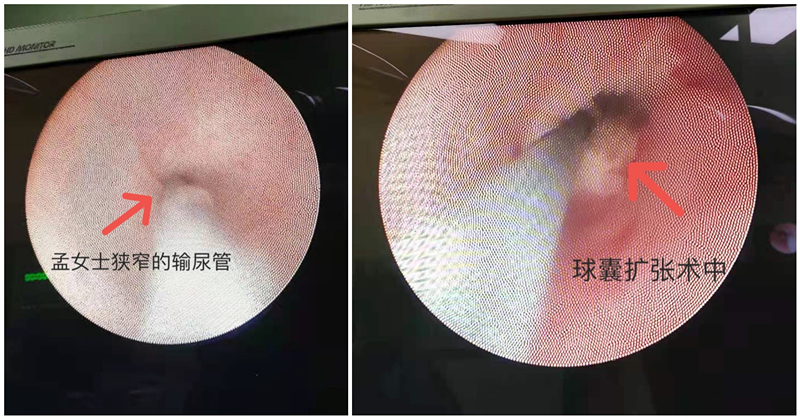 附屬同濟醫院泌尿外科運用微創創新技術為一患者治療輸尿管多段狹窄