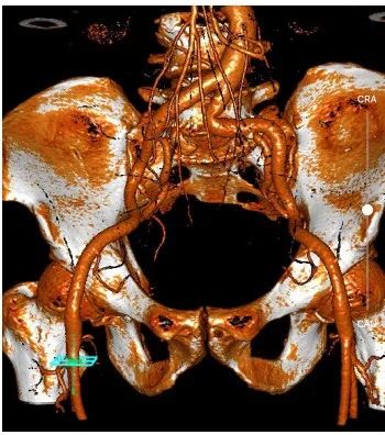 合肥京东方医院首例 TAVR 手术成功,心脏主动脉瓣置换现已进入「介入换新」时代