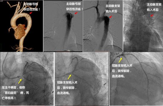 西安交通大学第一附属医院：  两科联动成功实施国内首例「一站式血管治疗」手术