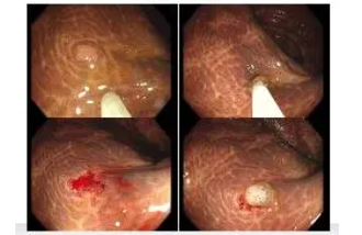 此「圈套」非彼「圈套」,治疗这类人群更安全、更高效