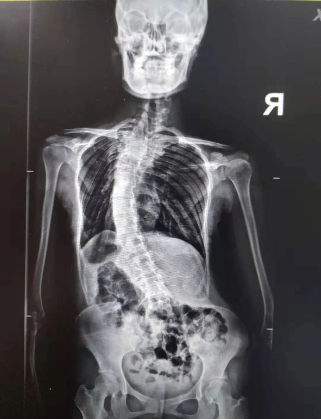 脊柱侧弯八年后实施矫正手术，19 岁女孩「增高」5 厘米