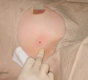 无痛不留疤！3 mm 切口拿下 3 cm 大小乳腺肿瘤，麦默通微创手术了解一下