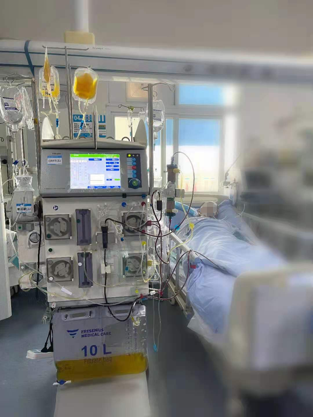 「置换」新生——华西广安医院运用血浆置换术成功抢救一名血栓性血小板减少性紫癜患者