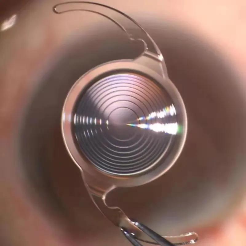 华润武钢总医院眼科成功实施首例连续视程人工晶体植入术