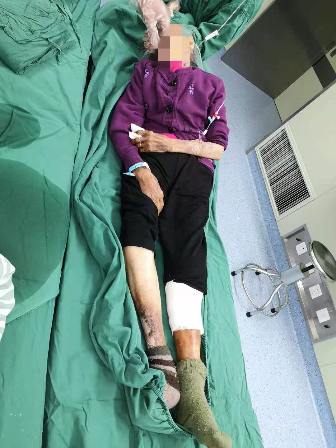 南昌大学第二附属医院整形美容科杨立文教授团队成功为 105 岁患者开展带蒂皮瓣移植术
