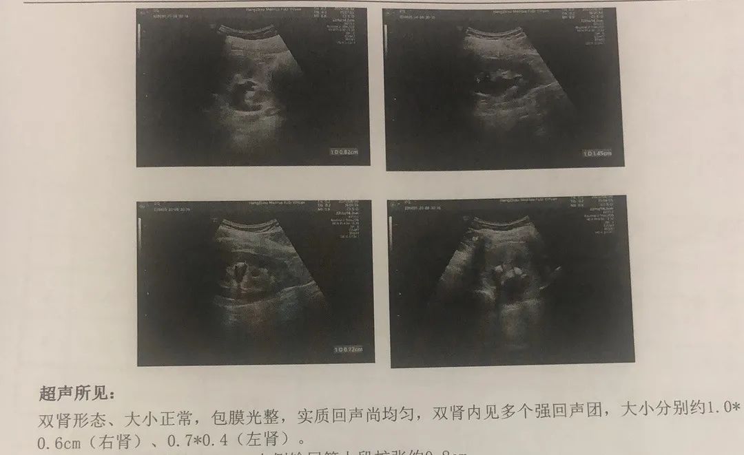 孕妇突发尿路结石，杭州贝瑞斯美华妇儿急诊剖宫，转危为安