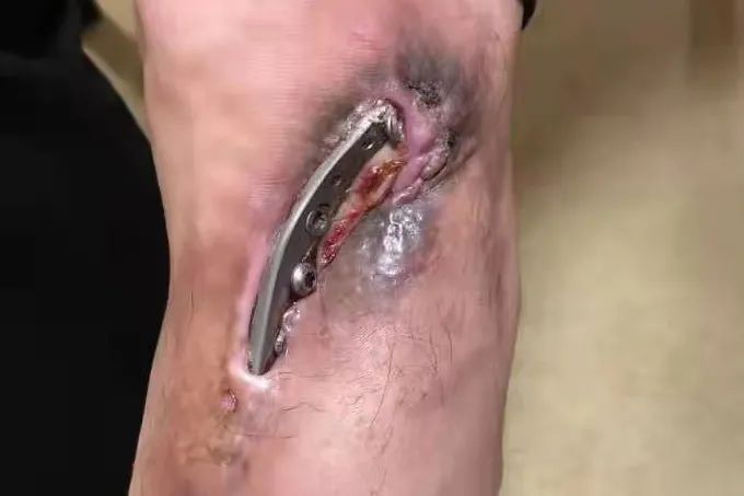 钢板戳出体外竟整整拖了 14 年，这位大伯太「硬核」