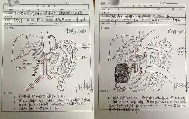 前海人寿广州总医院名誉院长汪建平教授手绘超赞「手术图谱」！