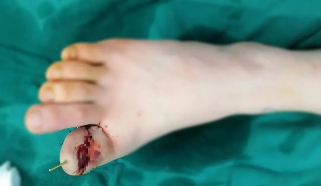 神奇！18 岁女孩面临截趾，医生一波操作，让趾骨缩短再延长，她的脚趾又「复原」了～