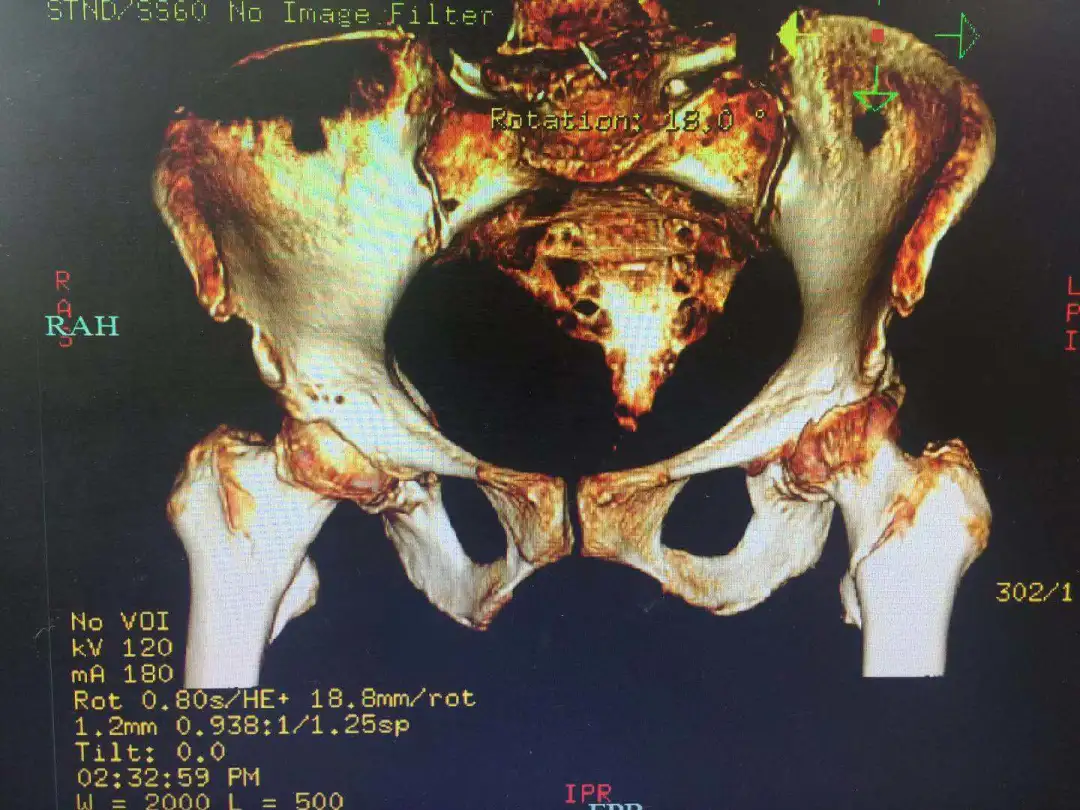 战胜「人生中的最后一次骨折」!上海海华医院多学科协作成功救治 3 名高龄骨折患者