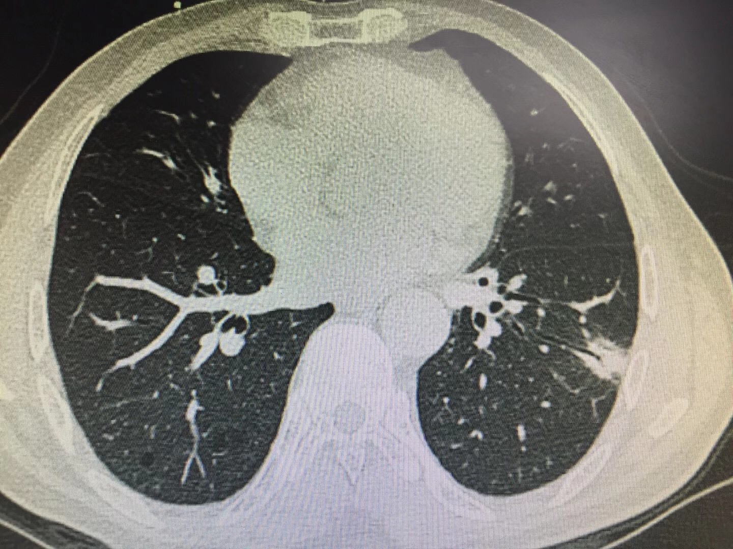 肺部占位须谨慎，肺隐球菌在作祟