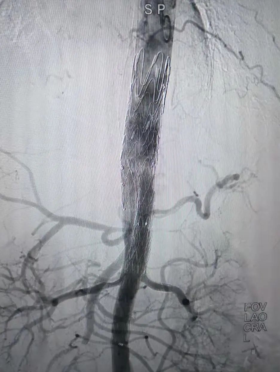 腔内「八爪鱼」技术，满足复杂血管手术需要
