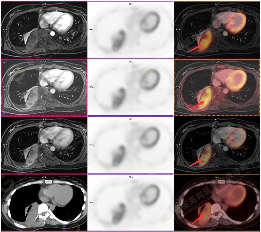 高尚病例：PET/CT-MR 诊断脊柱旁神经节细胞瘤一例