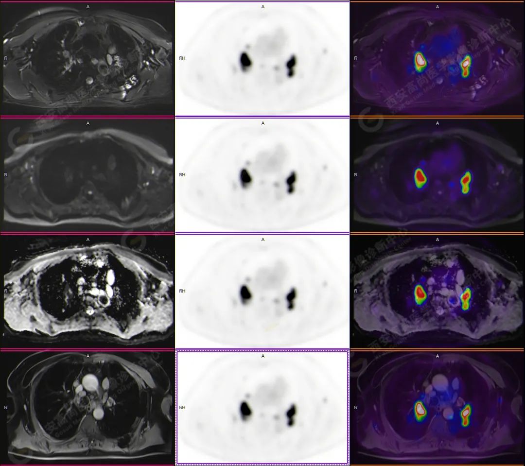 高尚病例：PET/CT-MR 诊断结节病双肺及全身多发淋巴结广泛累及 1 例