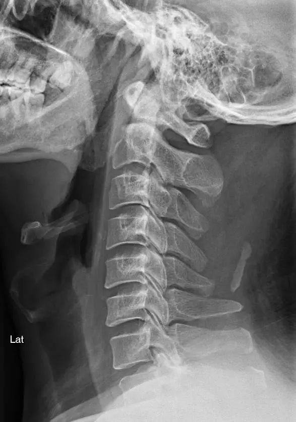 「微创+精准」——苏州明基医院成功为一位脊髓中央损伤综合症患者手术