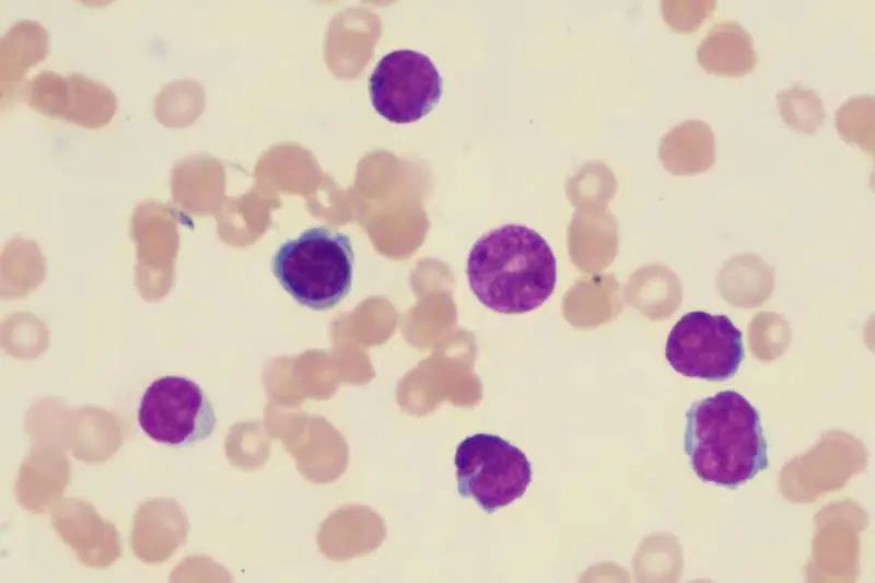 从「急淋」到「淋巴瘤」，揭秘鲜为人知的「隐形」侦探