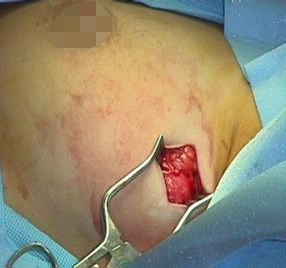 无痛不留疤！3 mm 切口拿下 3 cm 大小乳腺肿瘤，麦默通微创手术了解一下