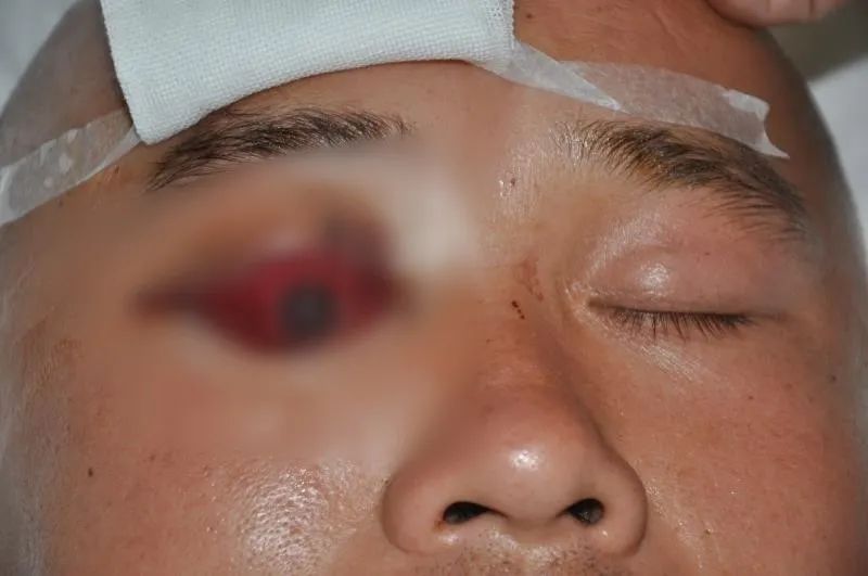 30 cm 木棍插入眼睛 河南省人民医院眼科专家另辟蹊径解决难题