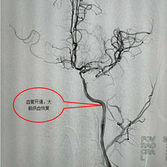 高精尖技术丨前海人寿广州总医院神经内科介入成功治疗罕见的双侧颈内动脉闭塞患者