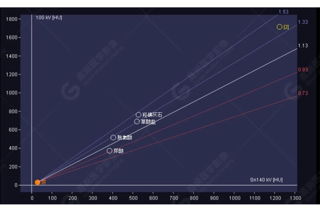 高尚病例:双能量 CT 成像分析泌尿系结石成分