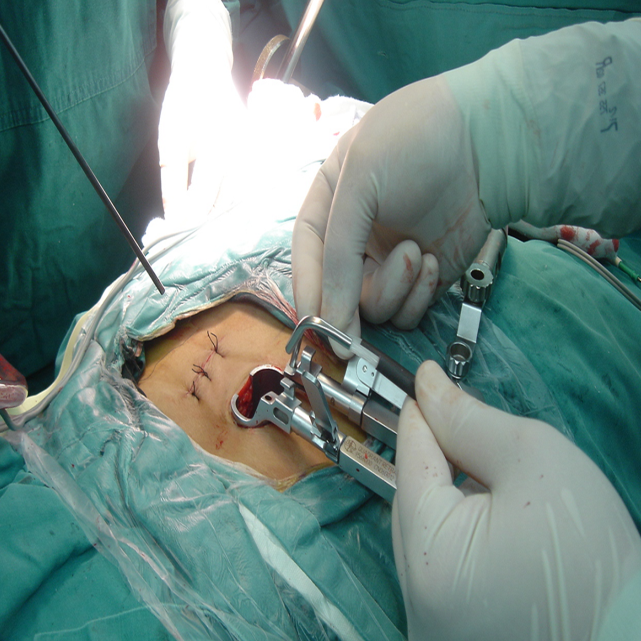 脊柱外科运用微创（MIS-TLIF）技术解除患者腰椎疼痛