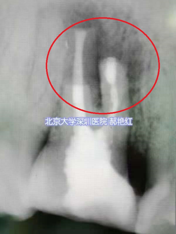 北大深圳医院医生15分钟内手术  巧手留住天然牙
