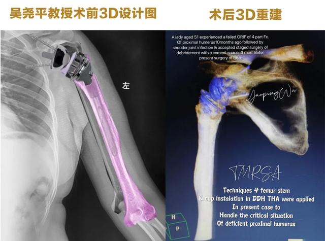 西安大兴医院骨科完成西北罕有复杂翻修反肩关节置换术