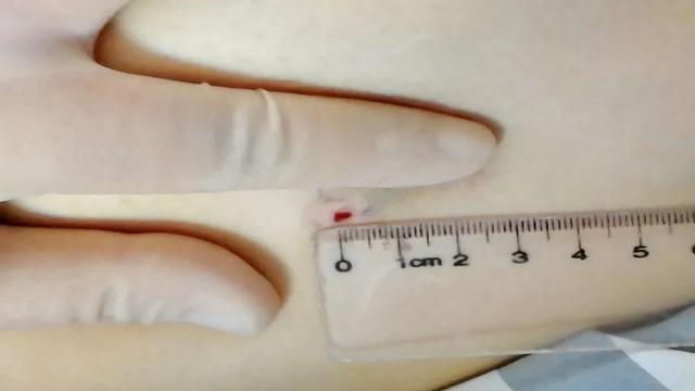 治疗肺部肿瘤新利器：不动刀，皮肤只有不足2毫米的针眼！