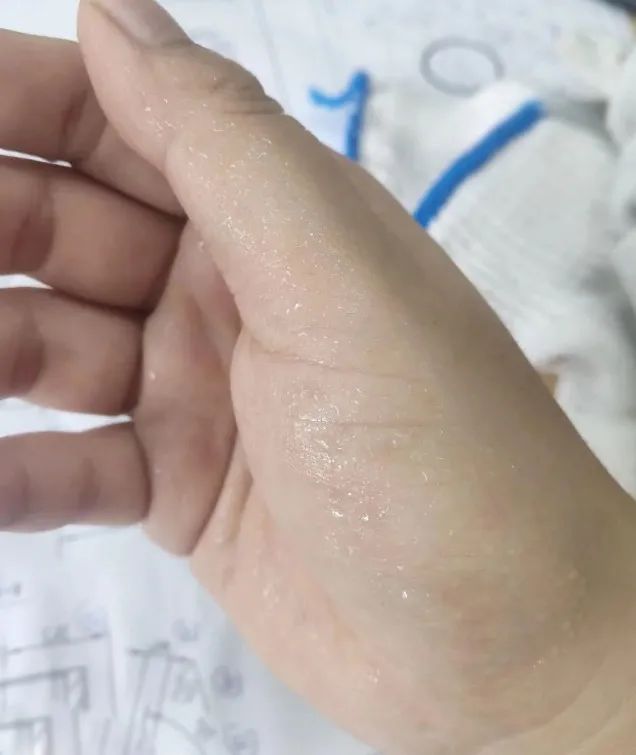 17 岁高中生「手汗症」写湿考卷，合肥京东方医院微创手术 30 分钟告别「水手」
