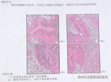 又遇到一个锁骨下长瘤子的患者，这种病要注意了