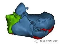 华润武钢总医院骨三科巧用 3D 打印技术，微创匠心解人忧