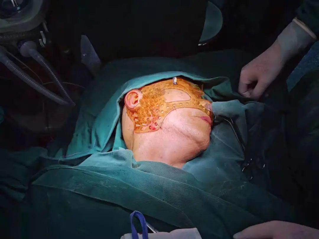 江西省口腔颌面外科首例「3D 打印非共面模板引导下放射粒子植入术」