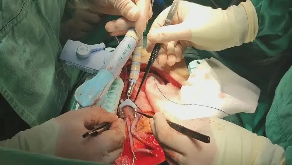 赤峰市宁城县中心医院心胸介入血管外科成功完成一例非体外循环下冠状动脉旁路移植术