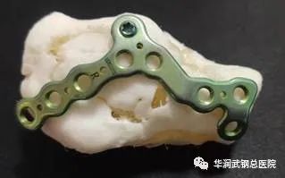 华润武钢总医院骨三科巧用 3D 打印技术，微创匠心解人忧