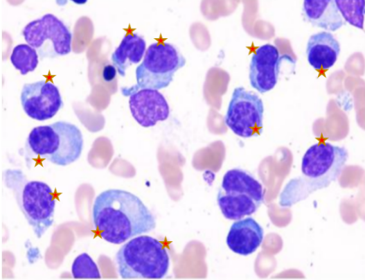 胡凯专栏丨追击多发性骨髓瘤终极难题：复发难治进展期浆细胞白血病