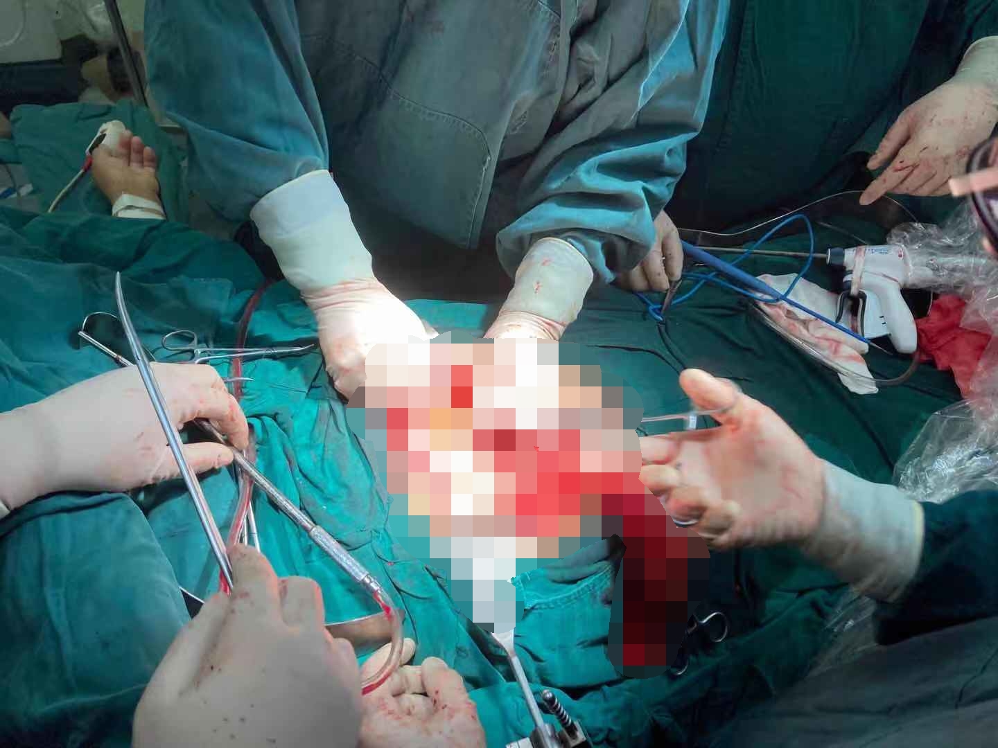 河南信合医院成功施行首例胰十二指肠切除术