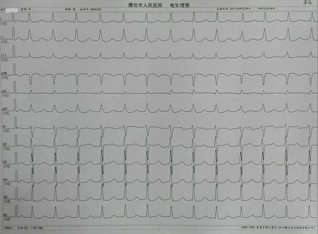 83 岁老奶奶成为潍坊市首例希氏束心脏起搏手术受益者