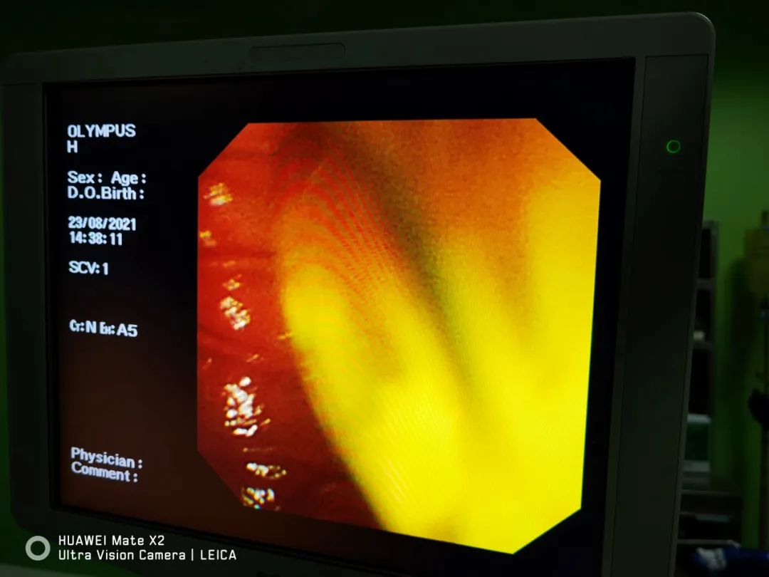 内镜下双支架植入打通梗阻的肝内外胆管