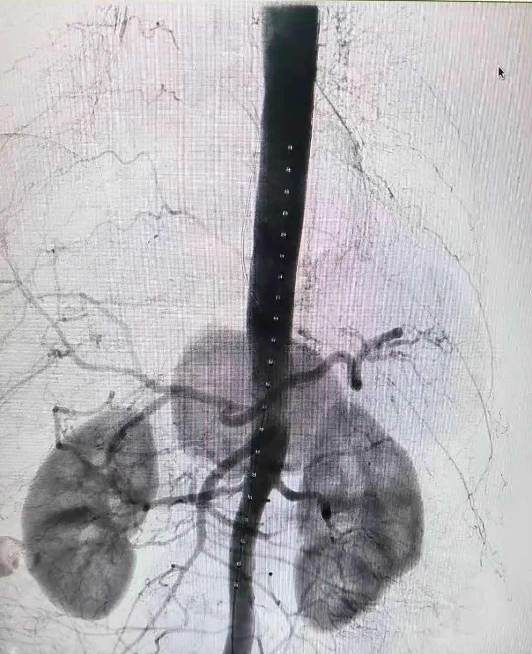 腔内「八爪鱼」技术，满足复杂血管手术需要