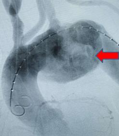 当高龄遇上罕见 10 厘米大主动脉瘤，武汉大学人民医院多学科协作不开胸为八旬老人「拆弹」