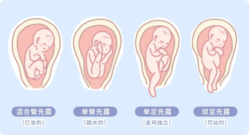 内检摸到宝宝一只脚，杭州美华紧急助力臀位妈妈顺利分娩