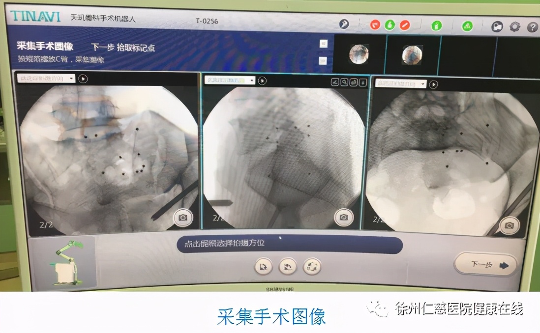 在骨科机器人辅助下轻松精准完成创伤骨科中的「最复杂手术」