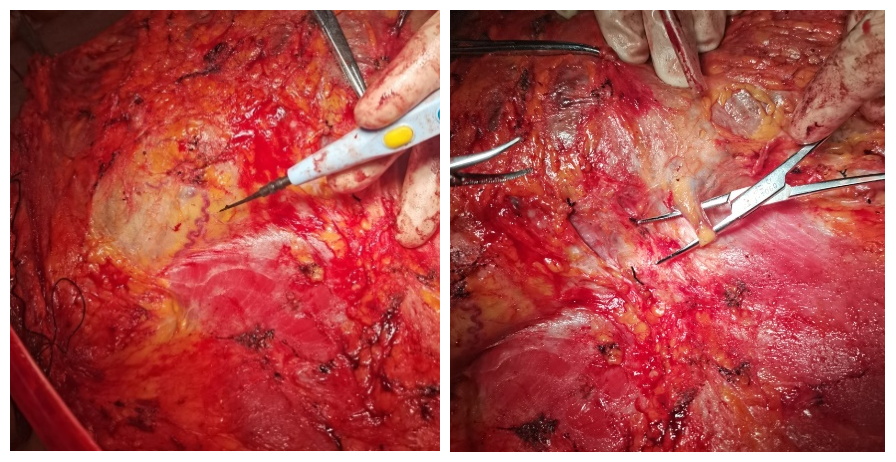 重庆西南医院整形外科联合多学科，成功为患者切除躯干部 16 斤重巨大难治性神经纤维瘤