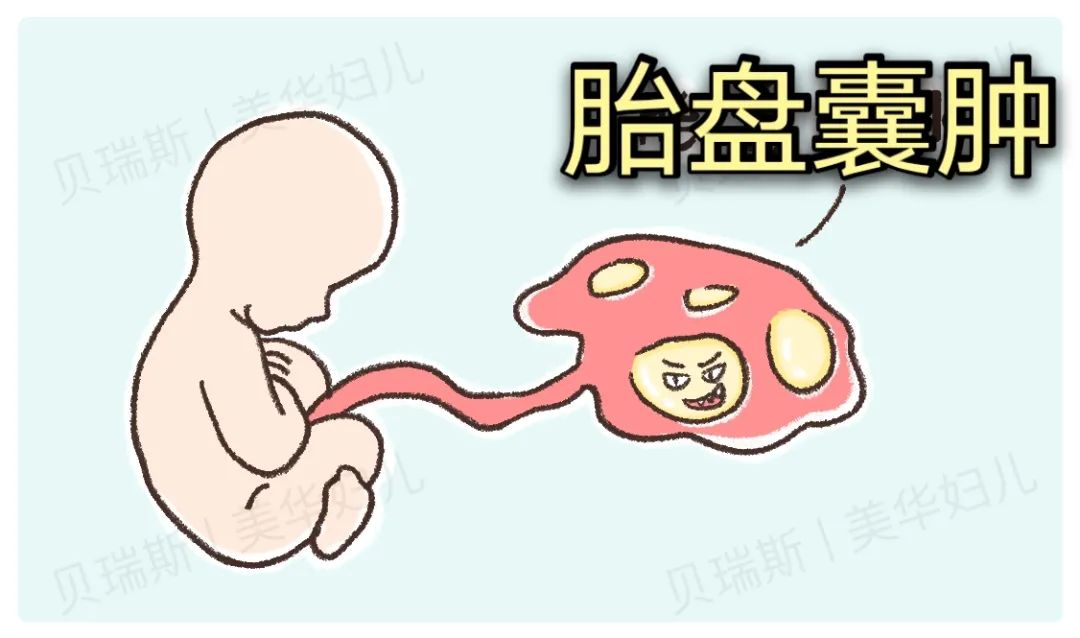 胎盘上竟长了 12 枚囊肿，最大的和拳头一般，产妇该如何渡关？