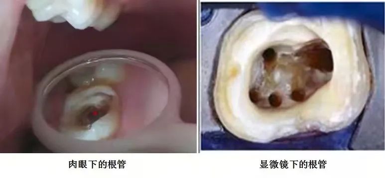 延大附院口腔医院牙体牙髓病科迈入显微治疗时代