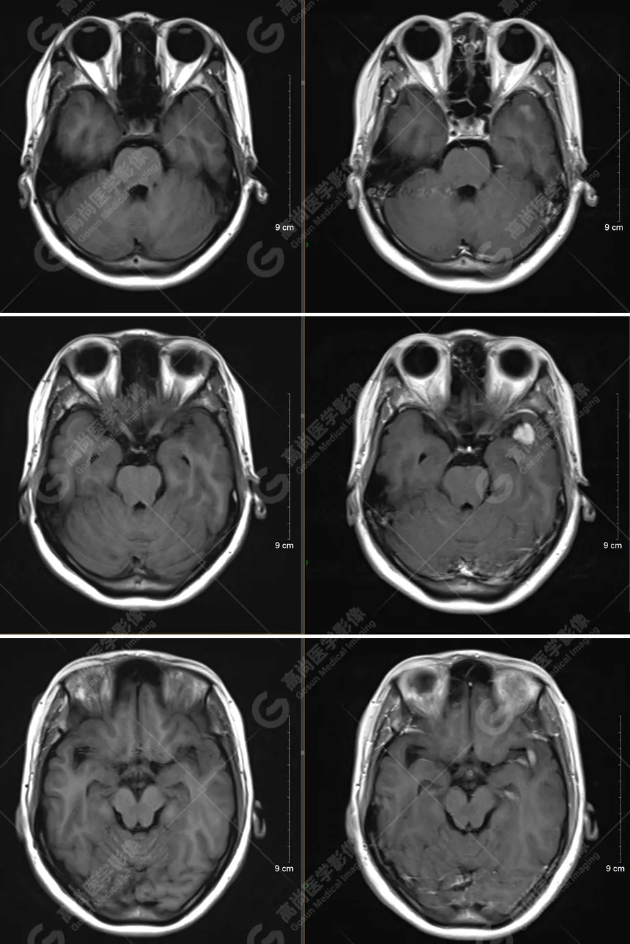 高尚病例：少见类型脑膜瘤回顾分析