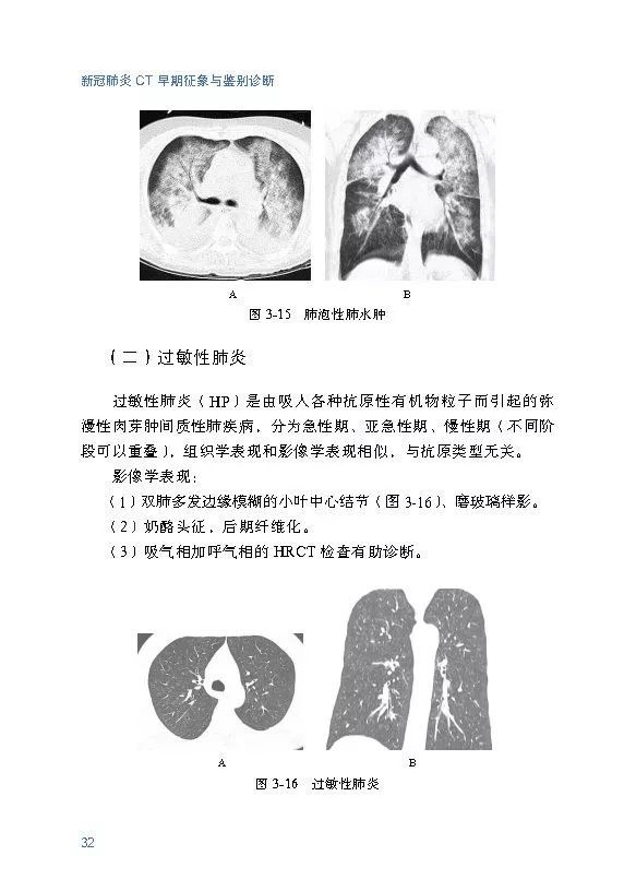 浙江省《新冠肺炎 CT 早期征象与鉴别诊断》出版并免费共享