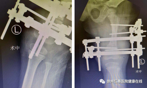 徐州仁慈医院矫形重建团队携手矫形专家彭爱民教授完成 6 岁患者左下肢骨延长