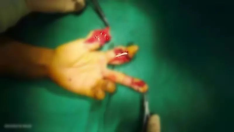 「移花接木」拇指再造，上海海华医院成功完成一例复杂拇指再造术