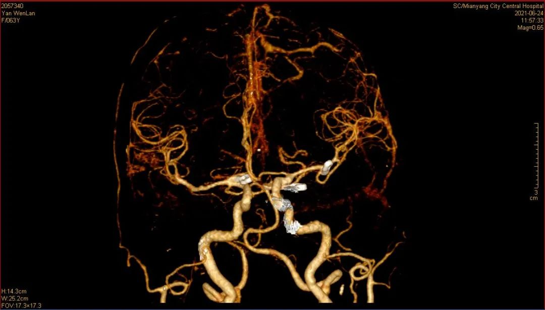 生死时速 绵阳市中心医院神经外科为患者成功摘除多个「颅内炸弹」